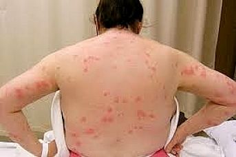Bed bug bites on the body