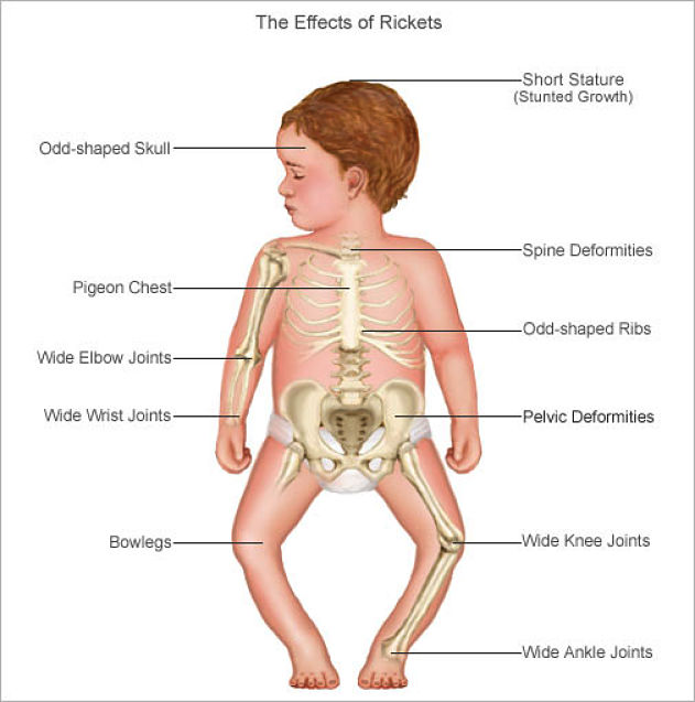Effects of Rickets in Children with a Deficiency of Vitamin D