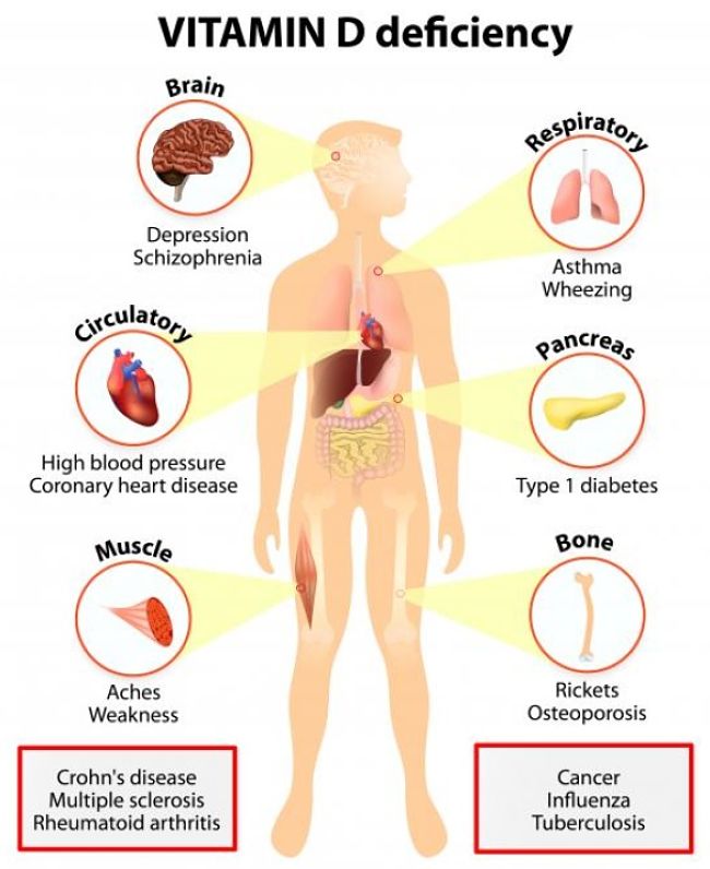 Symptoms of Health Problems related to a deficiency of Vitamin D in Adults