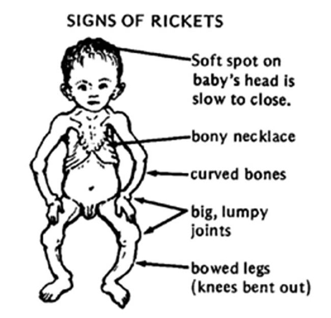 Signs and Symptoms of Rickets in Children