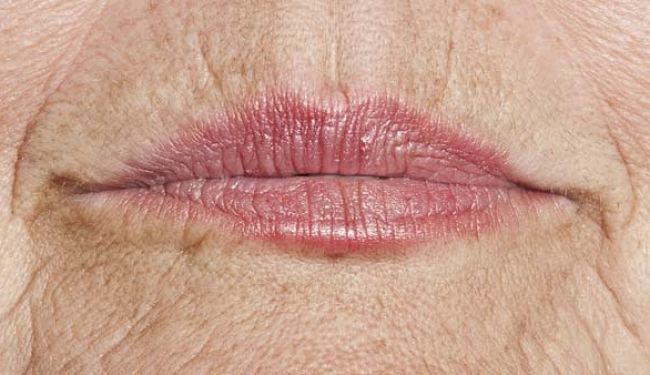 Wrinkly lips can be annoying and unattractive. Learn the cause of wrinkly lips, and how to prevent and treat them using natural remedies