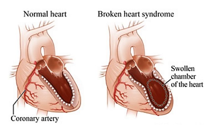 Can You Really Die Of A Broken Heart 