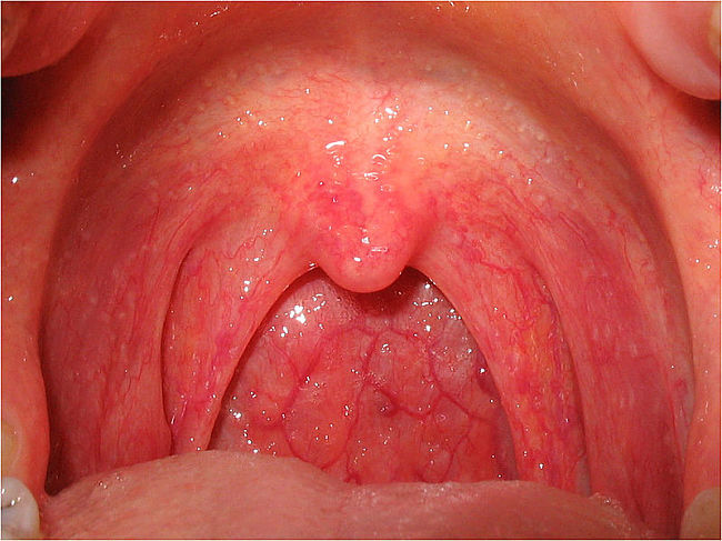 A sore throat that developed suddenly is a good sign that you have the flu rather than the common cold